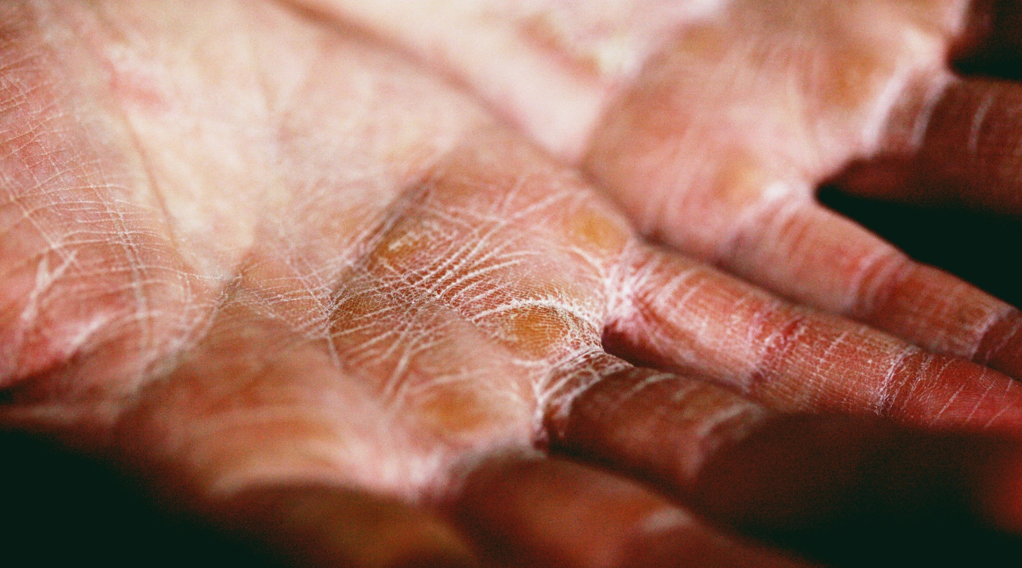 Eczema myths debunked