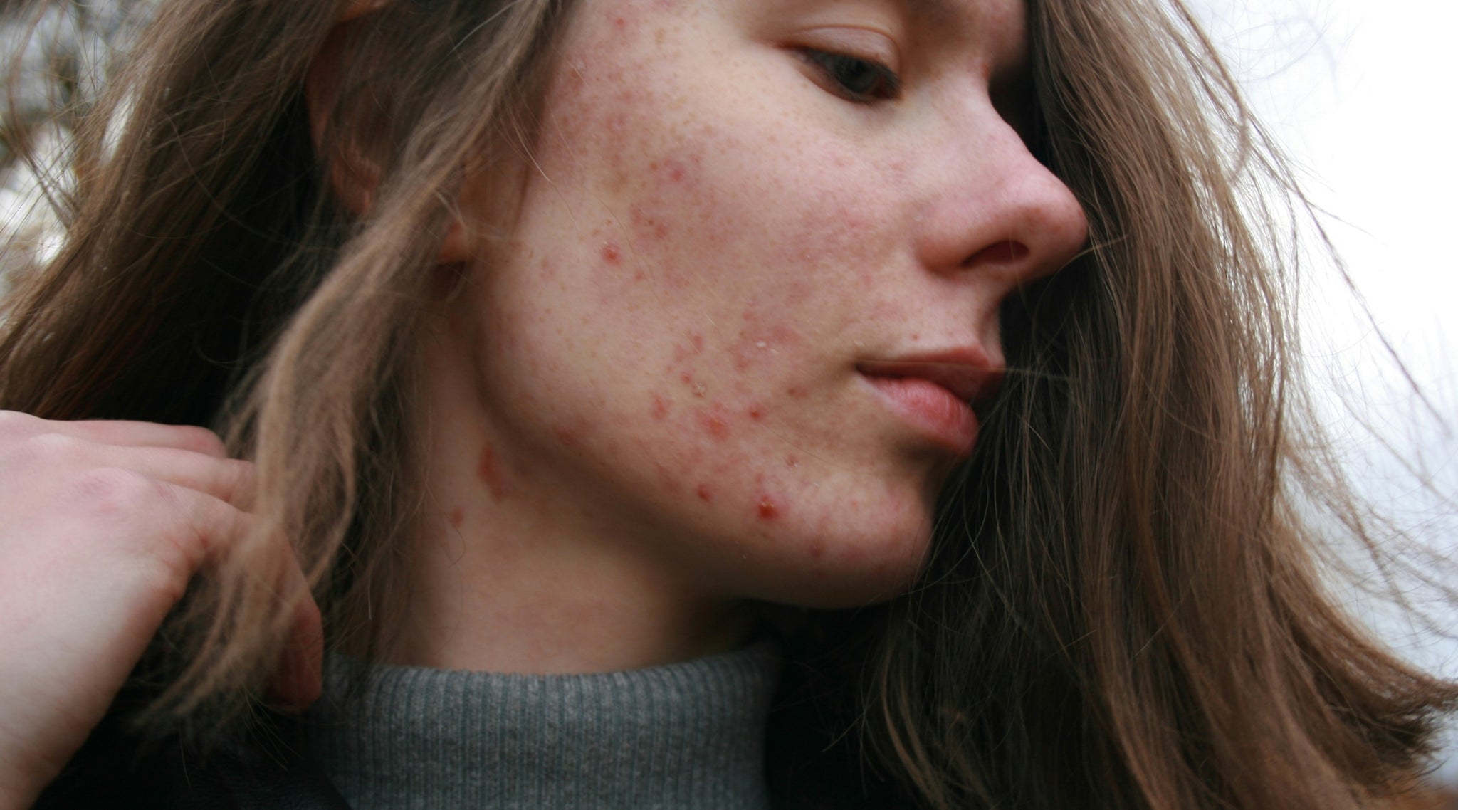 Treating acne safely and sustainably | A natural approach