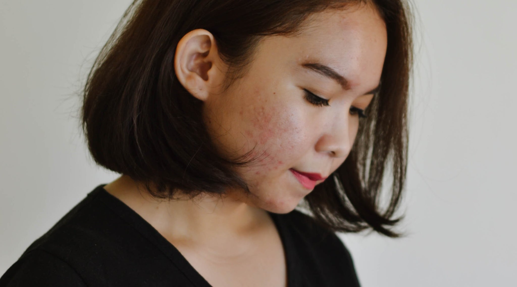 What causes Acne? | A word from our experts