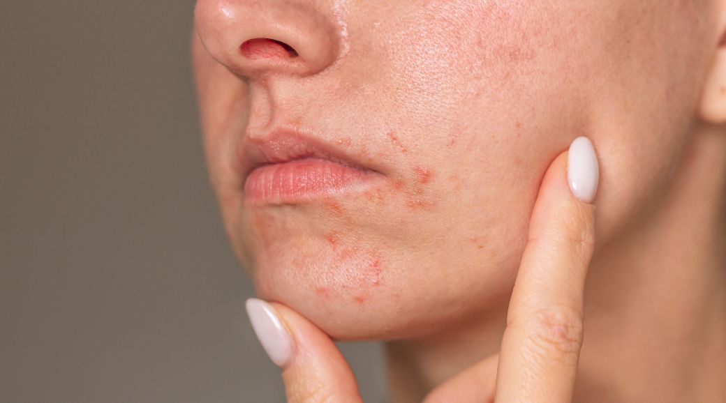 Perioral dermatitis | Our Dermatologist’s advice