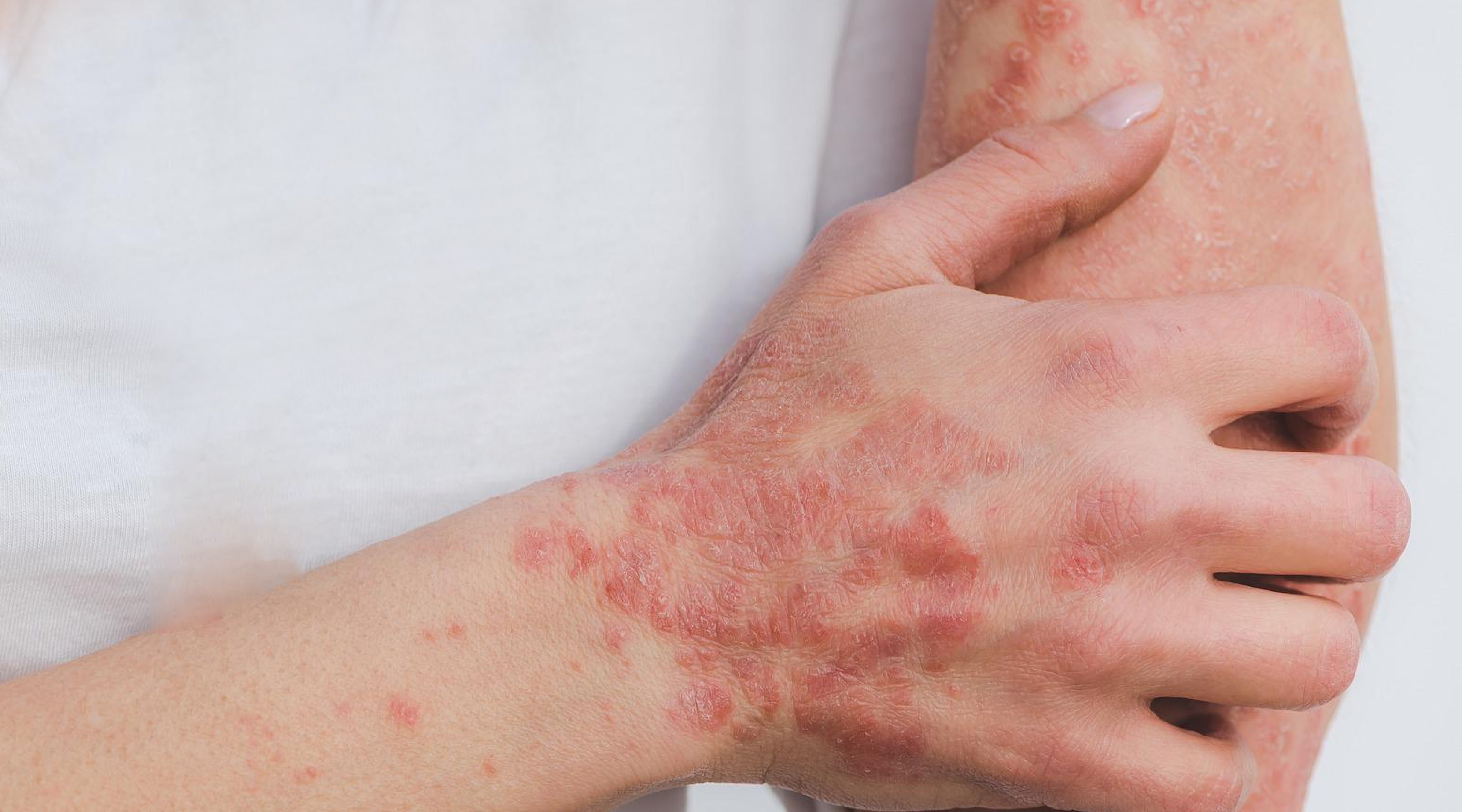 My skin story | Conquering psoriasis naturally