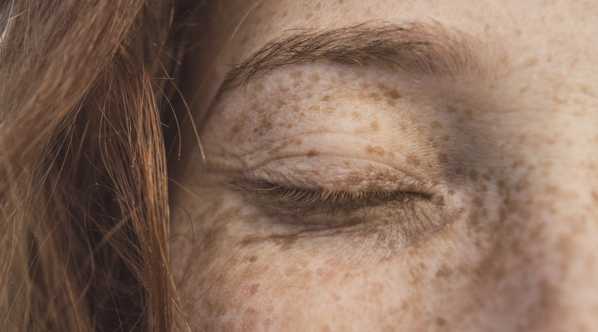 Hyperpigmentation | Our expert advice