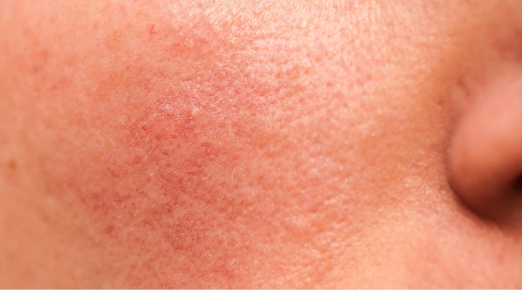 My skin story | Kara’s victory over rosacea