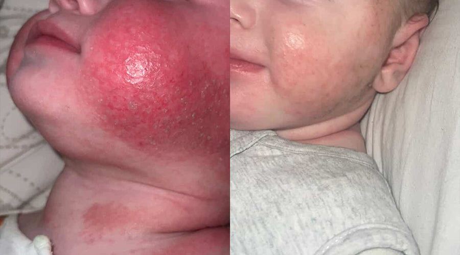Ronnie’s skin story | Relief for baby eczema, naturally